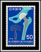 Artificial Hip